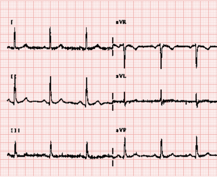 <p>QRS axis classification for this tracing</p>