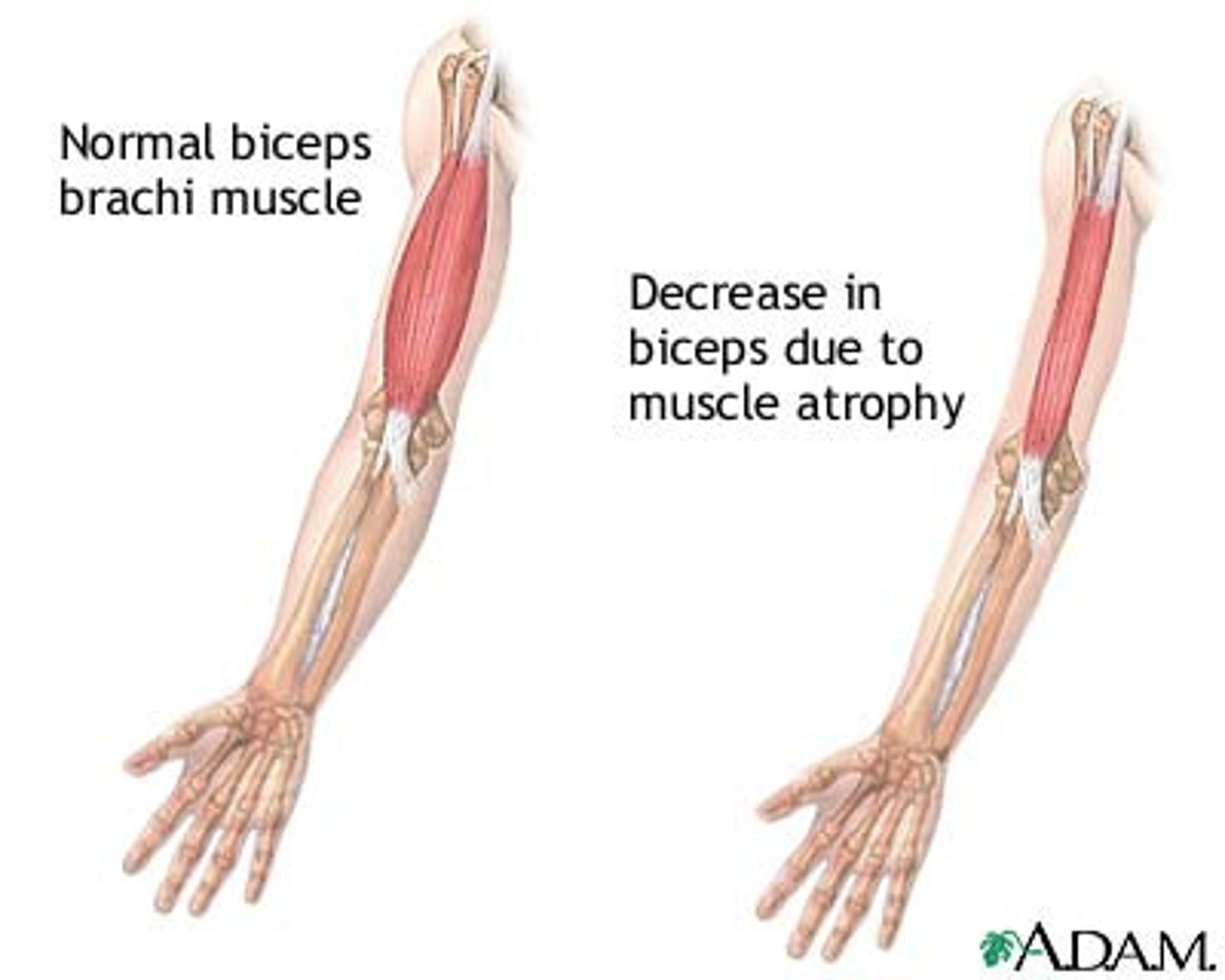 <p>decrease in the size of cell</p><p>-Reduced tissue mass</p><p>-Reversible</p><p>-Disuse, insufficient blood flow, malnutrition</p>