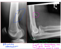 <p>If it points away then Pedunculated Osteochondroma, if ti points towards the joint space then is a supracondylar process</p>