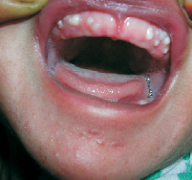 <p><span>nodules</span></p>