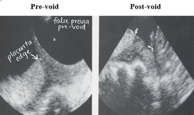 <ul><li><p>changing bladder shape can create appearance of placental movement or a change in placental shape</p></li><li><p><span style="color: red;">full bladder can elongate cervix and give false impression of previa</span></p></li><li><p><span style="color: yellow;">emptying bladder</span> allows cervix to be in normal position </p></li></ul><p></p><p>** have patient empty bladder and reimage if previa is seen</p><p></p>