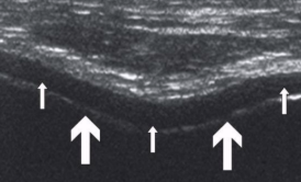 <p>H<span style="background-color: transparent;">ypoechoic noncompressible layer in contact with bone surface</span></p>
