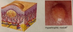 <p>elevated, firm, circumscribed lesion; deeper in dermis than a papule; 1-2 cm in diameter</p>