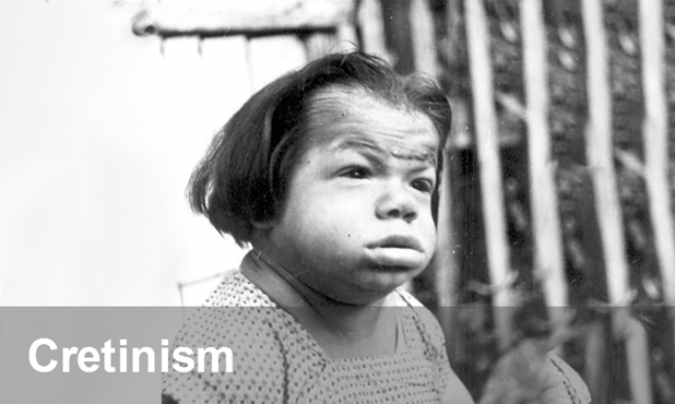 <p>Iodine Toxicity and Deficiency</p>