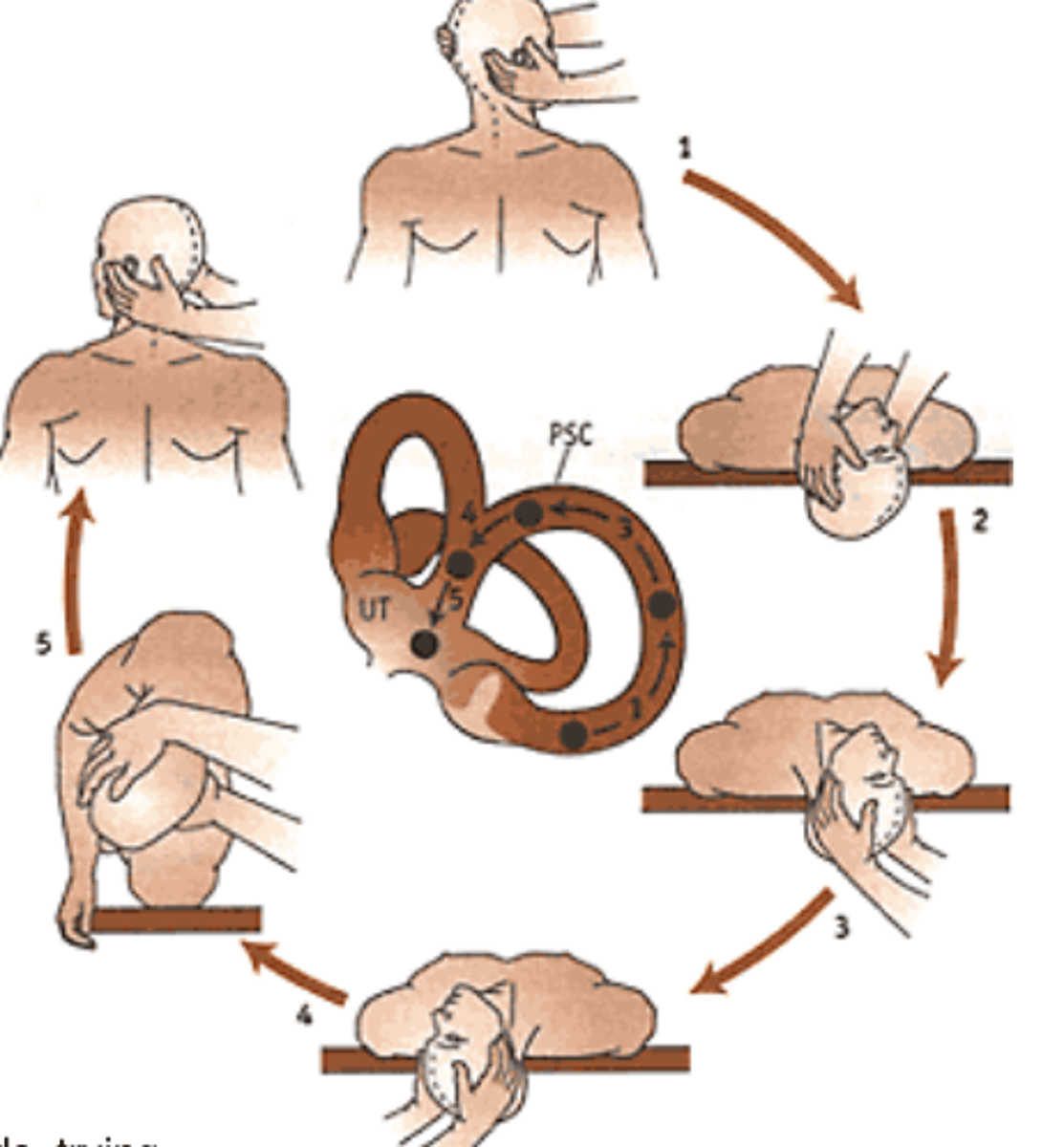 <p>- 45 deg to more symptomatic side and 30 deg below horizontal</p><p>- Rotate 45 deg to other side keeping 30 deg declination</p><p>- Roll to sidelying (uninvolved side), nose down</p><p>- Slowly sit up, maintaining head position flexed (chin tucked) and rotated</p><p>- Slowly return the head to upright and remain sitting 3-4 min, then repeat until no symptoms are seen</p>