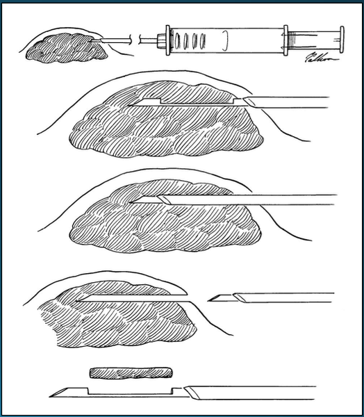 <p>This is an example of what kind of biopsy method? </p>