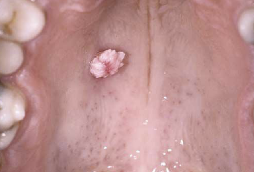<p>Base of Lesion : between sessile and pedunculated </p>