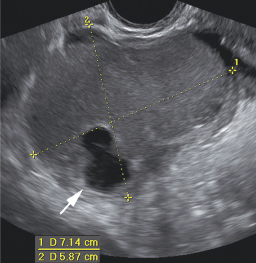 <p>2. The patient in Figure 21-26 complained of dysmenorrhea and infertility. The structure between the calipers was noted in the right adnexa. What is the most likely diagnosis?</p><p></p><p>a. Brenner tumor</p><p>b. PCOS</p><p>c. Endometrioma</p><p>d. Endometrioid</p>