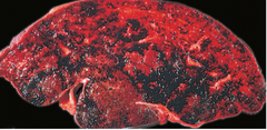 <p>Budd-Chiari Syndrome (post hepatic venous thrombosis). Associated with Polycythemia vera.</p>