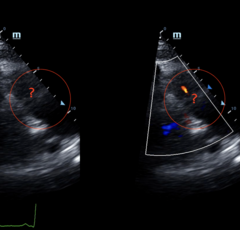<p>Right Ventricular Outflow Tract (RVOT) (Dual Screen Live)</p>