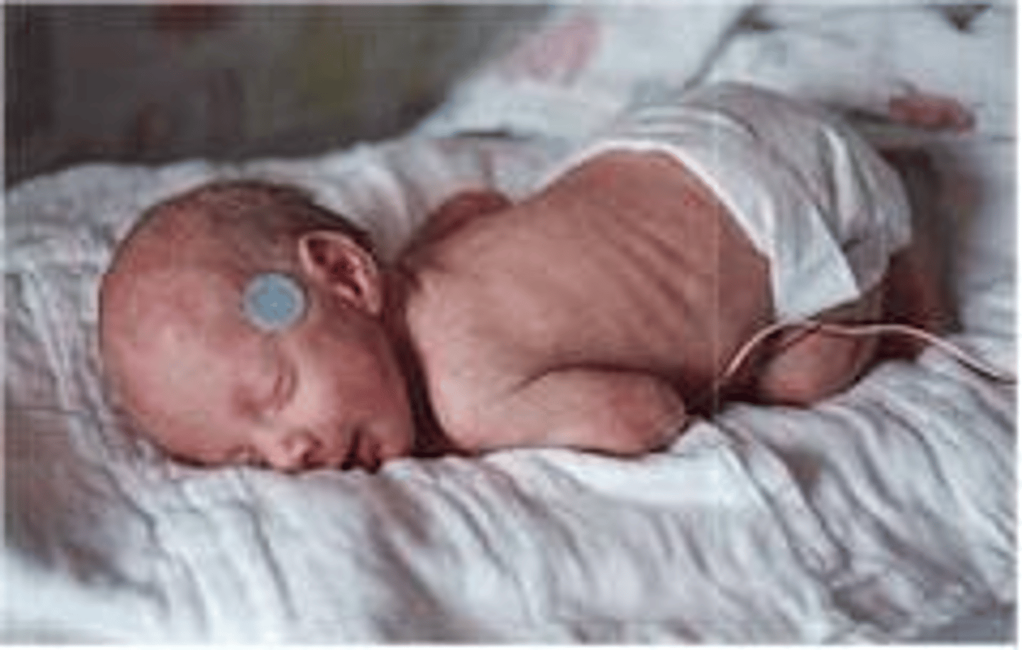 <p>Referring to a <u><mark data-color="#e4f8d1" style="background-color: rgb(228, 248, 209); color: inherit;">fetus not yet born as of 2 weeks after the due date</mark></u> or 42 weeks after the mother's last menstrual period.</p>