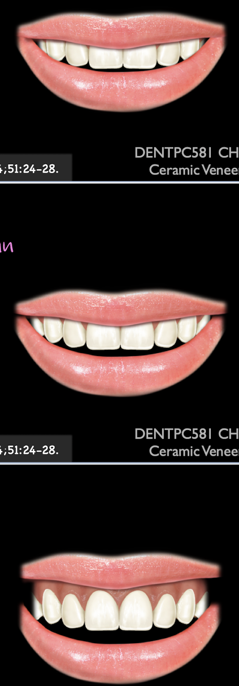 <ul><li><p>low smile </p></li><li><p>average smile </p></li><li><p>high smile </p></li></ul><p></p>