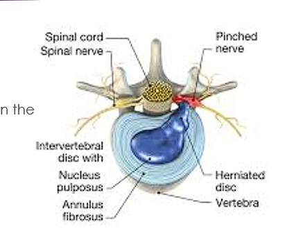 <ul><li><p><span style="color: red;">Bulging fibrous ring</span></p></li><li><p>Consists of concentric lamellae of fibrocartilage</p></li><li><p>Insert into smooth rounded epiphysial rims on the articular surface</p></li><li><p>Thinner posteriorly, may be incomplete in an adult in the cervical region</p></li><li><p><span style="color: red;">Decreasingly vascularized centrally</span></p></li><li><p><span style="color: red;">Outer third receives sensory innervation</span></p></li></ul><p></p>