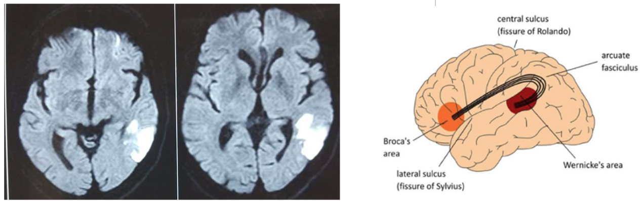 <p><span> Affects a person’s ability to understand and produce meaningful speech<br> Language comprehension is impaired</span></p><p><span><em>*</em>Fluent<br>*Paragrammatism (disordered grammar)<em><br> Paraphasia (replace phoneme or word withanother)<br> Neologism (generate nonsense words)<br></em>*Jargon (substitute non-related word/phrase)<br>* Comprehension (impaired understanding)</span></p>