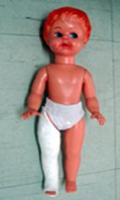 <p>fracture of the shaft of femur with callus formation</p>