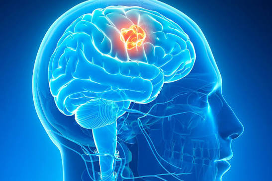 <p>n. An abnormal growth of cells inside the head that can affect how a person thinks, moves, or feels.</p>
