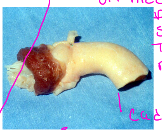 <p>• No anticoagulation</p><p>• SBE prevention</p>