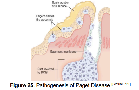 <p>DCIS Special Type: Paget Disease of the Nipple</p>