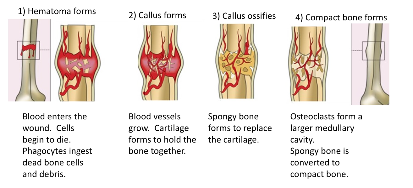 <p>Four Stages of Bone Repair</p>