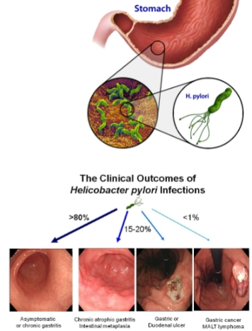 <ul><li><p>resides in the stomach</p></li><li><p>infects proximately 50% of the world population → 20% eventually develop symptoms (gastric cancer)</p></li><li><p>role model for chronic infection</p></li></ul><p></p><ol><li><p><span>Kolonisatie in de maagwand (mucuslaag) = H. pylori gaat niet los in het maagzuur leven, maar kruipt de slijmlaag in dicht bij het epitheel → daar is de pH minder extreem en is het ook minder bereikbaar voor veel afweerfactoren</span></p></li></ol><p></p><ol start="2"><li><p>Overleven bij lage pH via urease = de bacterie maakt het enzym urease → dit zet ureum om in ammoniak + CO2 → Ammoniak bindt H → de omgeving wordt lokaal minder zuur waardoor H. pylori kan overleven</p></li></ol><p></p><ol start="3"><li><p>Ontwijken van het aangeboren (innate) immuunsysteem = normaal herkennen Toll-like receptors (TLRs) bacteriële patronen zoals LPS en flagelline</p></li></ol><p></p><ol start="4"><li><p>Ontwijken van het verworven (adaptive) immuunsysteem via virulentiefactoren CagA en VacA = H. pylori scheidt belangrijke effectoren uit, vooral CagA en VacA → die kunnen immuuncellen bijsturen/remmen en helpen zo een chronische infectie in stand te houden</p></li></ol><p></p><ol start="5"><li><p>CagA remt B-celrespons (JAK-STAT remming) = deze figuur zoomt in op 1 effect: CagA kan B-celproliferatie remmen door interferentie met de JAK-STAT signaalroute Gevolg: zwakkere antistofrespons, waardoor bacterie langer kan blijven zitten</p></li></ol><p></p><ol start="6"><li><p>CagA remt ook B-cel apoptose → kan bijdragen aan kanker = geprogrammeerde celdood → waardoor B-cellen langer kunnen overleven → dit helpt de bacterie indirect (ontregeling) en kan bijdragen aan maligniteit</p></li></ol><p></p><ol start="7"><li><p><span>VacA remt T-cel proliferatie en cytokineproductie = T-cellen moeten actief worden en delen (prolifereren) om een sterke adaptieve respons te maken → VacA kan de TCR-signalling blokkeren (T-cell receptor) waardoor - T-cellen minder goed activeren en minder delen - minder cytokines worden aangemaakt Gevolg: een zwakkere T-cel hulp</span></p></li></ol><p></p><ol start="8"><li><p>Overleven in/inside epithelial cells = H. pylori kan ook tijdelijk intracellulair overleven in epitheelcellen → als een pathogeen in cellen zit, is het: - minder zichtbaar voor antistoffen - vaak moeilijker te clearen door immuunsysteem</p></li></ol><p></p><ol start="9"><li><p>Veranderen van virulentiefactoren (antigenic variation / phase variation) = “genetic rearrangement” → de bacterie kan delen van virulentiefactoren aanpassen/variëren <br>Effect: het immuunsysteem maakt een gerichte respons tegen versie A, maar de bacterie “switcht” naar versie B → immune escape en persistentie</p></li></ol><p></p>