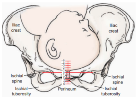 Ischial Spines