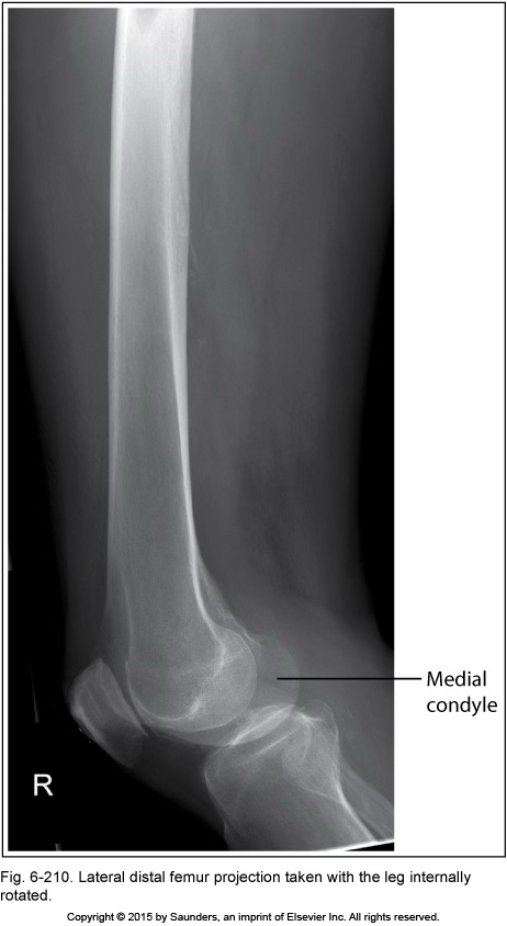 <p>lateral femur</p>