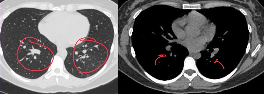 <p>CT of pt shows</p>