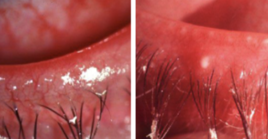 <p><span style="background-color: transparent;">_______<strong> Blepharitis</strong>:</span></p><ul><li><p><span style="background-color: transparent;">_______<strong> </strong>Blepharitis</span></p><ul><li><p><span style="background-color: transparent;">Greasy lid margin with lashes sticking together</span></p></li><li><p><span style="background-color: transparent;">Scales on lid margin + lashes</span></p></li><li><p><span style="background-color: transparent;"><u>Dry eye symptoms</u> present in many patients</span></p></li><li><p><span style="background-color: transparent;">Associated Conditions: dermatitis on <u>face and scalp Acne</u>, Rosacea, Eczema, Use of <u>retinoids</u></span></p></li><li><p><span style="background-color: transparent;">Frequent with:</span></p><ul><li><p><span style="background-color: transparent;"><u>Oily or greasy</u> eyelid deposits</span></p></li><li><p><span style="background-color: transparent;"><u>Mild</u> injection (Conjunctiva)</span></p></li><li><p><span style="background-color: transparent;">Aqueous Tear deficiency</span></p></li><li><p><span style="background-color: transparent;"><u>Inferior</u> punctate epithelial erosions (cornea)</span></p></li><li><p><span style="background-color: transparent;">Derm Disease: _______ <u>dermatitis</u></span></p></li></ul></li></ul></li></ul><p></p>