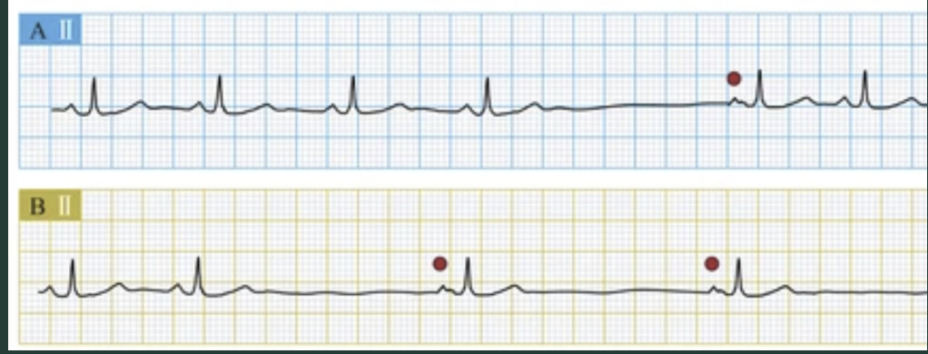 <p>What two things are these ECG showing?</p>
