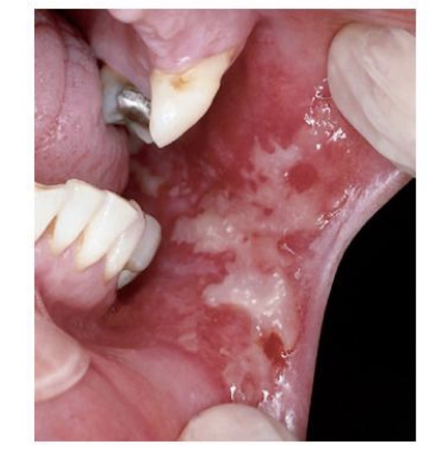 <p>BN SAU XẠ TRỊ</p><p>NIÊM MẠC SƯNG NỀ, ĐỎ, LOÉT VÀ ĐAU</p><p>CHẨN ĐOÁN?</p>