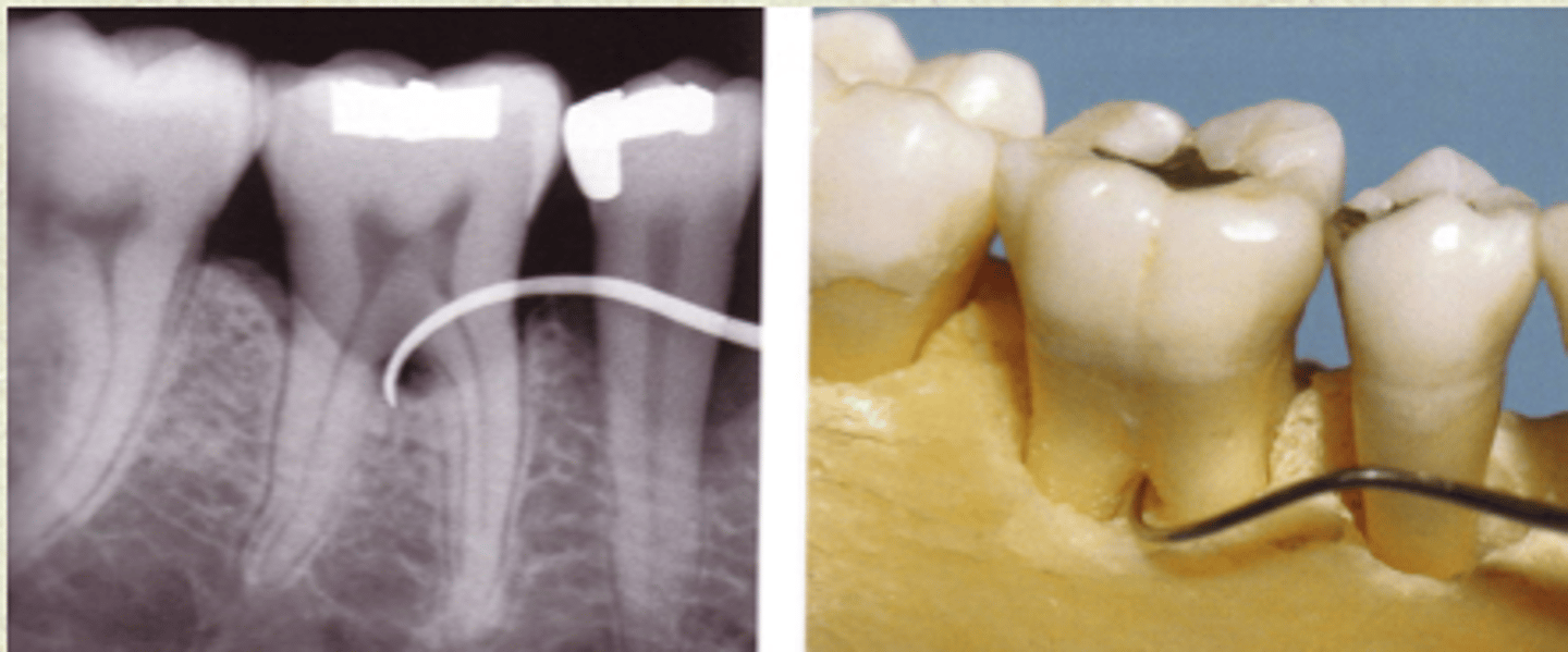 <p>bone loss through and through</p><p>radiographic evidence</p>