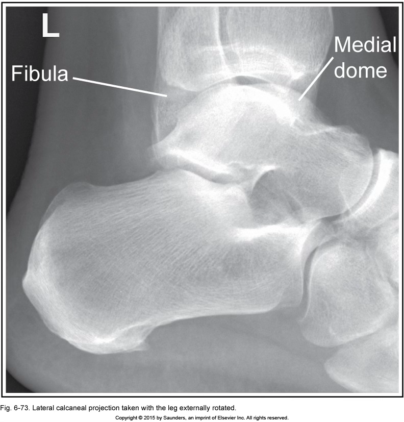 <p>lateral calcaneus</p>