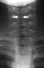 <p>This x-ray image indicates what pathology?</p>