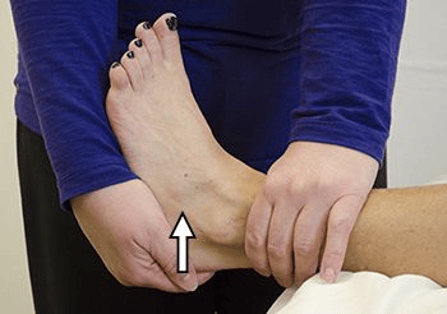 <p>4,4</p><p>1. Midtarsal stress is not the traditional method of injury for any single ligament, including anterior talofibular ligament.</p><p>2. Dorsiflexion would be the most likely mechanism of injury for the anterior tibiofibular ligament (high ankle sprain), not the anterior talofibular ligament. The integrity of the anterior tibiofibular ligament would be tested with a dorsiflexion/rotation maneuver, not a straight anterior glide.</p><p>3. Eversion would be the most likely mechanism of injury for the deltoid ligament, not the anterior talofibular ligament. The integrity of the deltoid ligament would be tested with a straight eversion stress, not a straight anterior glide.</p><p>4. The photograph shows an Anterior Drawer Test, which is used to evaluate the anterior talofibular ligament. This is the ligament that is injured most often with an inversion mechanism.</p>