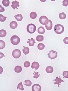 <p>Severe hepatic disease; alcohol intoxication (Zieve’s syndrome); pyruvate kinase deficiency; congenital abetalipoproteinemia; vitamin E deficiency; post-splenectomy.</p>