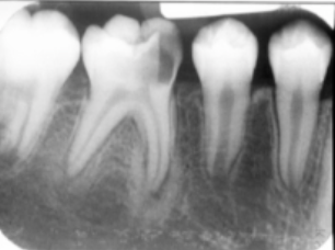 <p>which of the following is FALSE regarding the radio-opaque lesion? </p><p>no biopsy </p><p>will subside after treatment </p><p>due to infecttion </p><p>always at tooth apex </p>