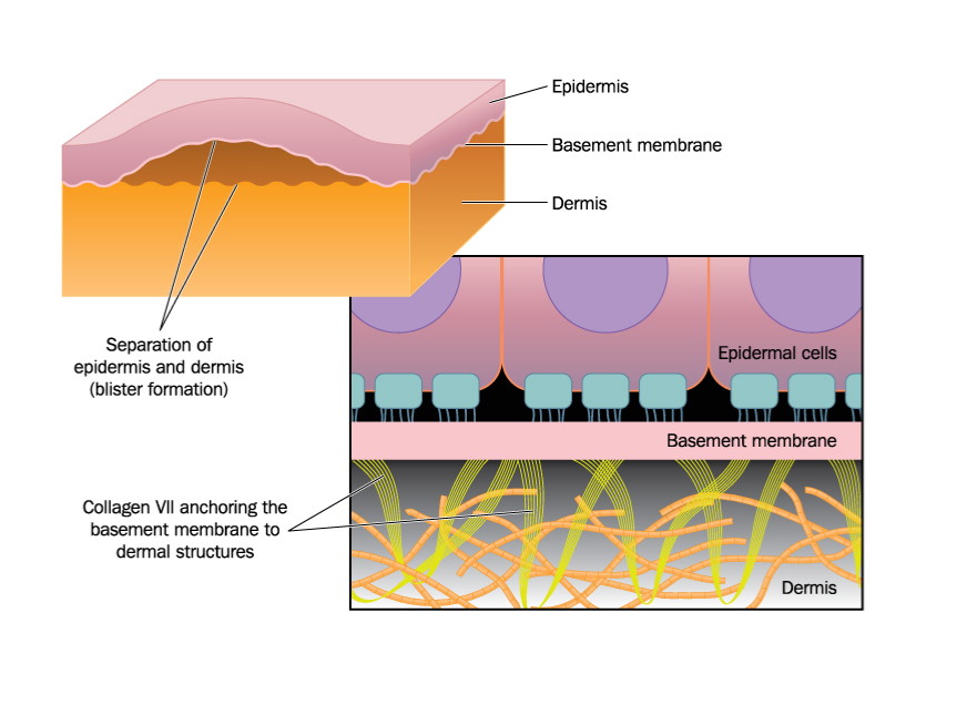 <p>Stress hits the skin at an angle and causes the epidermis to buckle and separate from the dermis, the raised dermal cells die. Fluid rushes into the area and new layers eventually form. Stress can tear the healing dermis of a blister and fluid will rush out of the tear, this is prone to infection.</p>