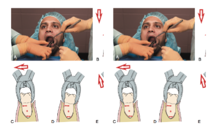 <p>• Apical pressure is used to expand the socket</p><p>• Bucco-lingual motion (mostly buccal) is used to expand the socket</p><p>• Figure 8 movement can be used to continue expanding the socket</p>