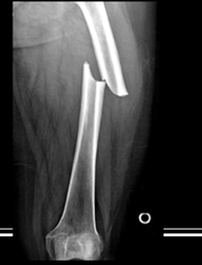 <p>- fractured bone parts are out of anatomic alignment</p>