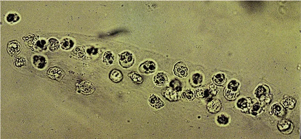 <p><strong>White Blood Cell (WBC) casts</strong> (indicates inflammation or infection in the nephron). </p>