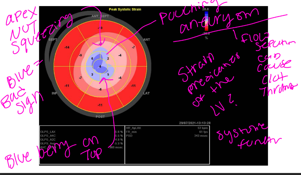 <p>Strain is a predictor of the LV dysfunction  greater then -18 is normal</p><p>blue is that anerusymal site - blue is bad, apical ansurysm, called the blue berry on top </p>