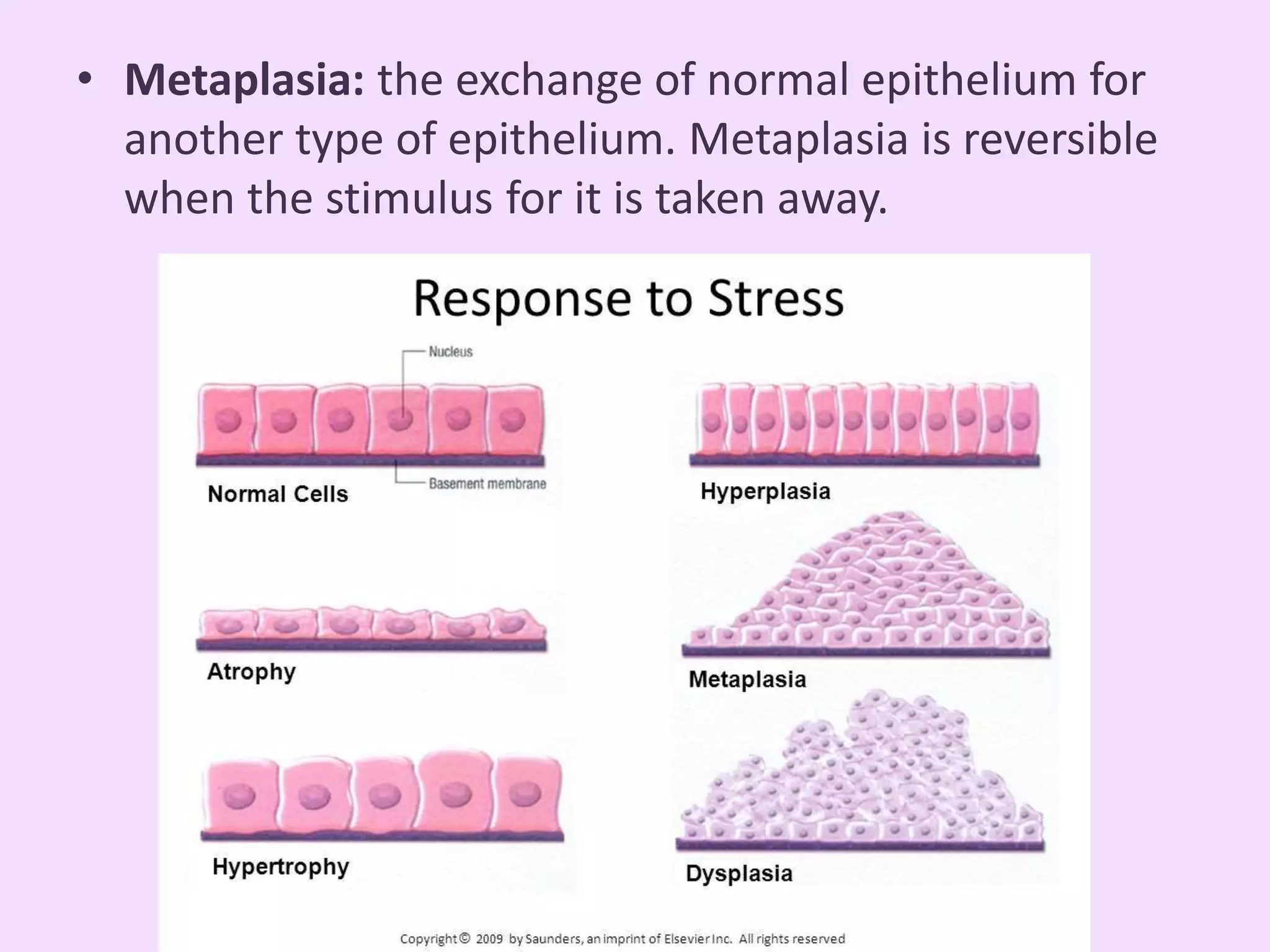 <p>The replacement of one mature cell type by another resilient cell type in response to chronic stress, injury, or irritation</p>