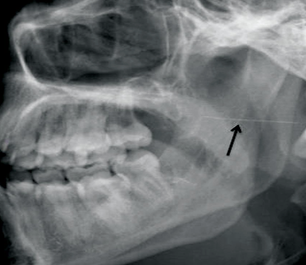 <p><strong>Prevention:</strong> Needle Breakage</p>