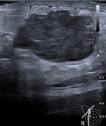 <p>Describe the pathology </p>