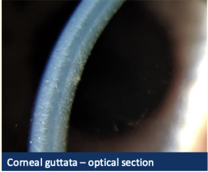 <ul><li><p>Fuchs endothelial dystrophy </p></li></ul><p></p><ul><li><p>corneal oedema </p></li><li><p>haze of stroma </p></li><li><p>Corneal guttata —> beaten metal appearance </p></li><li><p>brown pigment spots </p></li><li><p>lines are fold in descemets membrane </p></li></ul><p></p>