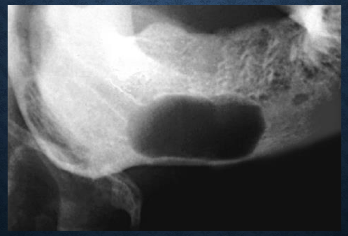 <p>what is the epicenter of this lesion and what does that tell you?</p>