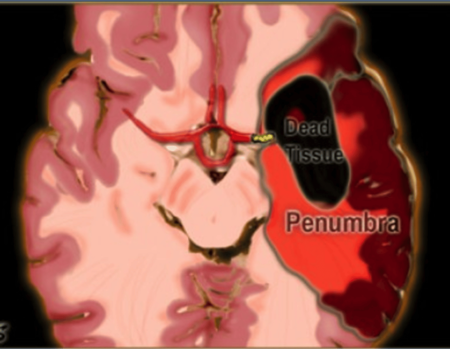 <p>ischemic tissue further upstream relative to core</p><p>tissue CAN be recovered</p>