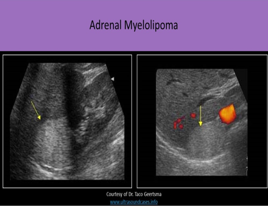 <p>D. adrenal tumor that is composed of fat and bony elements</p><p>An adrenal myelolipoma usually originates in the adrenal cortex and is composed of fat and bony elements. The mass is hyperechoic and causes varied levels of sound attenuation, posterior shadowing and propagation speed artifact. Large masses can be associated with acute retroperitoneal hemorrhage. These masses can be associated with Cushing syndrome, Conn syndrome and adrenal hyperplasia.</p>