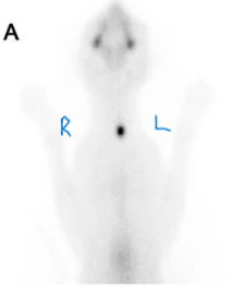 <p>The scintigraphy result is now being interpreted. The image shows:</p><p>• Left thyroid lobe: markedly increased tracer uptake (bright hotspot)</p><p>• Right thyroid lobe: very low to absent tracer uptake</p><p>• Salivary glands: symmetric faint uptake bilaterally (expected normal finding)</p><p>The clinician presents four possible interpretations of this pattern to the team.</p><p>Feline Thyroid scintigraphy</p><p></p><p><strong>Which interpretation of this scintigraphic pattern is most consistent with the clinical presentation and correctly applies the principle that tracer uptake reflects metabolic activity?</strong></p><p><span>a. Both thyroid lobes are diseased — the left lobe is hyperactive (producing excess hormone) and the right lobe has been destroyed by the disease process, explaining the absent uptake.</span></p><p><span>b. The left lobe is anatomically enlarged, causing it to take up more tracer simply due to greater tissue mass — the right lobe appears absent because it is smaller and its signal is below the detection threshold, not because it is functionally different.</span></p><p><span>c. The scintigraphy result is non-diagnostic because asymmetric uptake could represent either a normal variant or disease — additional imaging with MRI would be needed to determine which lobe is abnormal.</span></p><p><span>d. The left lobe has increased metabolic activity results in high tracer uptake. The right lobe shows suppressed uptake because excess T4 from the left lobe has suppressed pituitary TSH, withdrawing the normal trophic stimulus from the right lobe and reducing its functional activity to below detectable levels.</span></p><p></p>