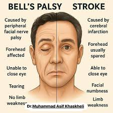 <ul><li><p><span style="background-color: transparent; font-family: "Times New Roman", serif;">Stroke</span></p></li><li><p><span style="background-color: transparent; font-family: "Times New Roman", serif;">Bell’s palsy</span></p></li><li><p><span style="background-color: transparent; font-family: "Times New Roman", serif;">Migraines (can mimic a stroke)</span></p></li></ul><p>(Hate that that image is most likely AI)</p>